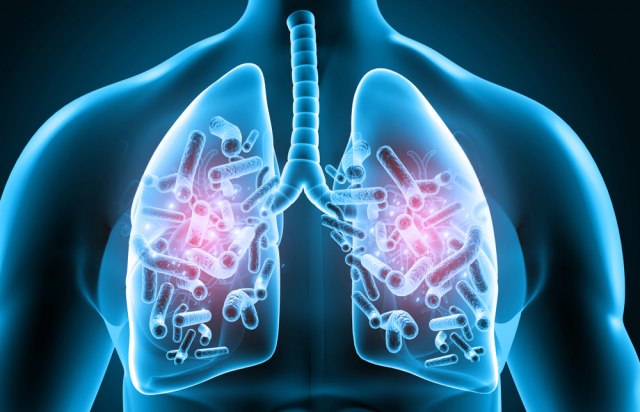 Katastrofa na pomolu: Šta je legionarska bolest i zašto je pogubna za hronične bolesnike